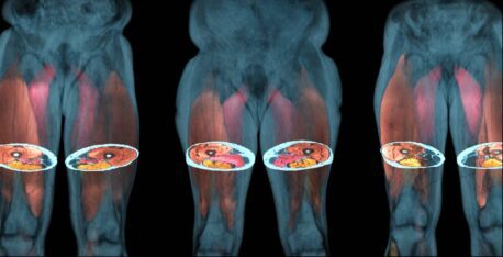 Muscle Fat Replacement and Functional Decline in Neuromuscular Disorders – Quantitative Skeletal Muscle MRI in Clinical Trials